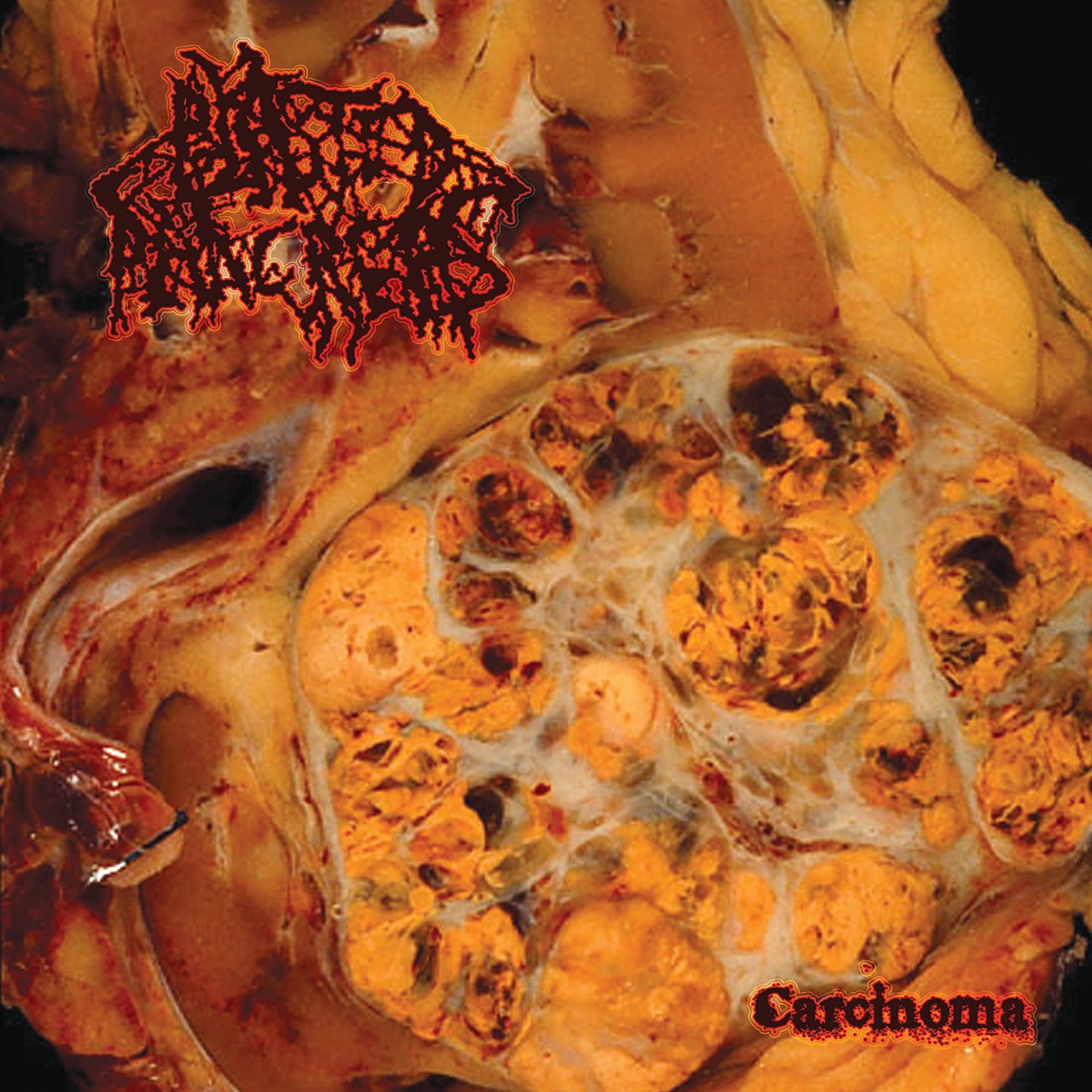 Blasted Pancreas Carcinoma CD